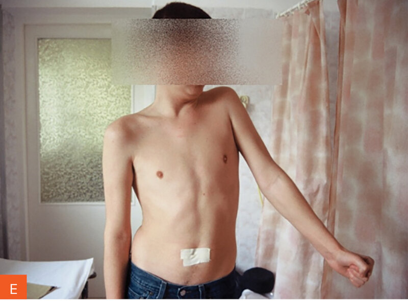 Rycina 5A-F. Jednostronne zaniki mięśniowe. A-D. Stan po miesiącu od ostrej fazy choroby. E, F. Stan po roku i wielomiesięcznej rehabilitacji porażenia czterokończynowego