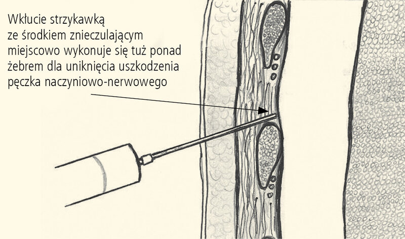 Rycina 4. Znieczulenie nasiękowe miejsca założenia drenu.