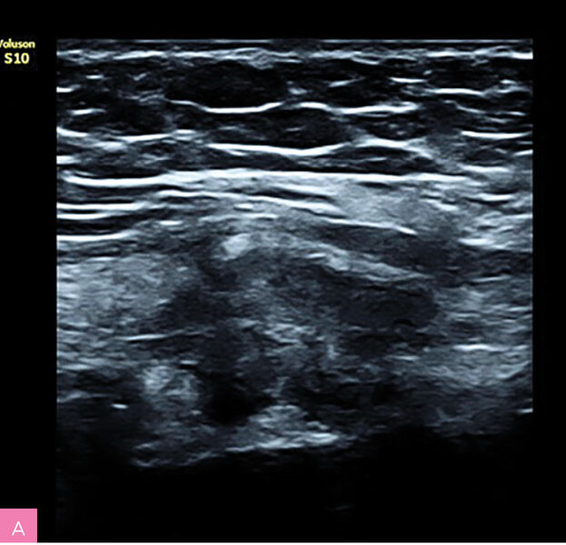 Rycina 1A, B. Obraz ultrasonograficzny zmiany endometrialnej powłok brzucha z typowymi spikularnymi brzegami  (materiał własny autorki)