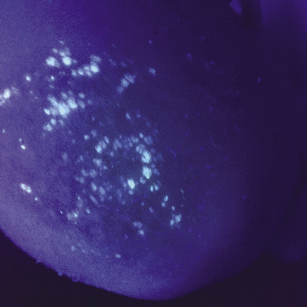 Rycina 4. Zielonkawa fluorescencja w lampie Wooda