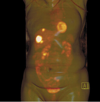 Ryc. 1. Badanie PET-CT po podaniu 18FDG. Zmiany przerzutowe do wątroby w przebiegu raka jelita grubego.