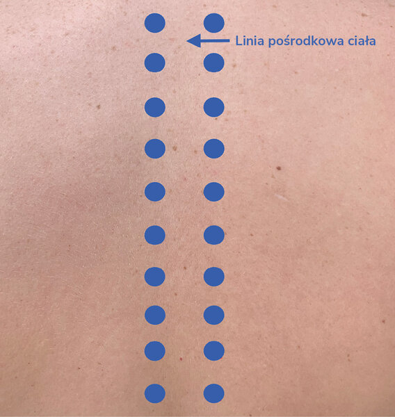 Rycina 4. Orientacyjne punkty iniekcyjne stosowane w mezoterapii w przebiegu zespołu bólowego kręgosłupa piersiowego