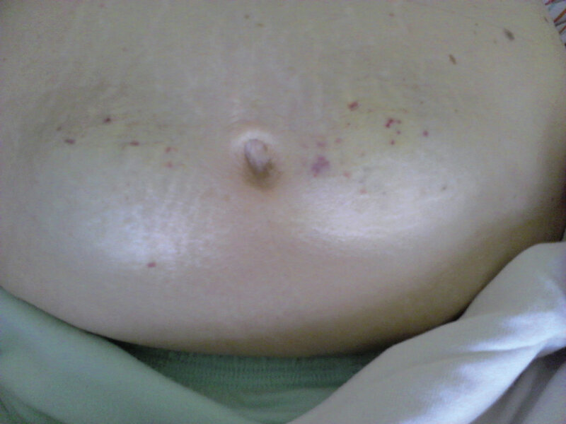Ryc. 5. Lipohipertrofia u chorego leczonego insuliną.