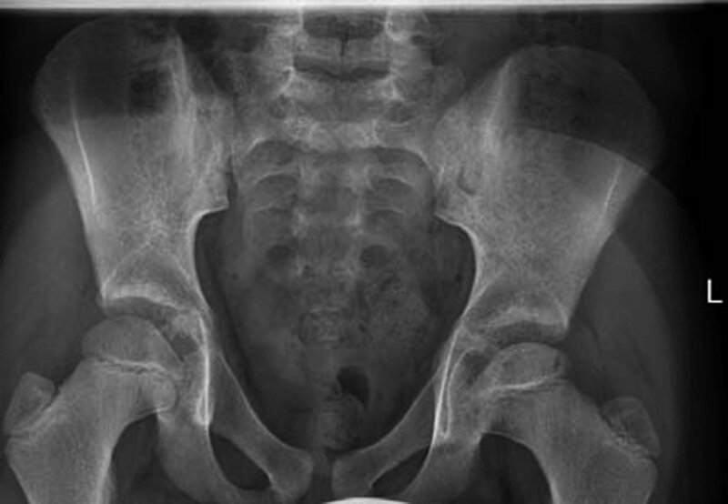 Rycina 2. Faza I choroby Perthesa. Minimalne zmiany radiologiczne:  zmniejszenie głowy i rozrzedzenie struktury kostnej dobrze widoczne  w bocznym kwadrancie głowy lewej kości udowej.