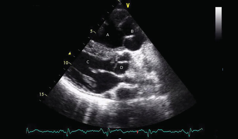 Rycina 2. Obraz echokardiograficzny pacjenta po operacji D-TGA metodą wewnątrzprzedsionkową – projekcja przymostkowa długa.  A – anatomicznie prawa komora systemowa, B – aorta, C – anatomicznie lewa komora podpłucna, D – pień płucny