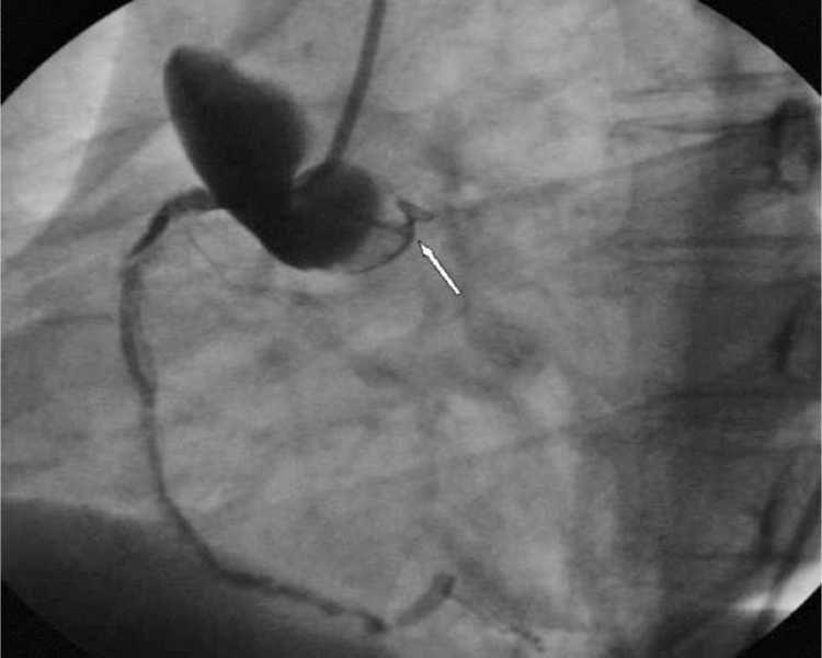 Rycina 2. Jatrogenna dyssekcja aorty w trakcie koronarografii (angiogram).