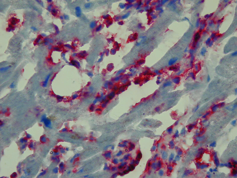 Rycina 3. Biopsja endomiokardialna. Kardiomiopatia rozstrzeniowa zapalna. Obecny nasilony naciek limfocytarny składający się z komórek CD3(+) (czerwony kolor). Reakcja immunohistochemiczna na skrawkach mrożeniowych