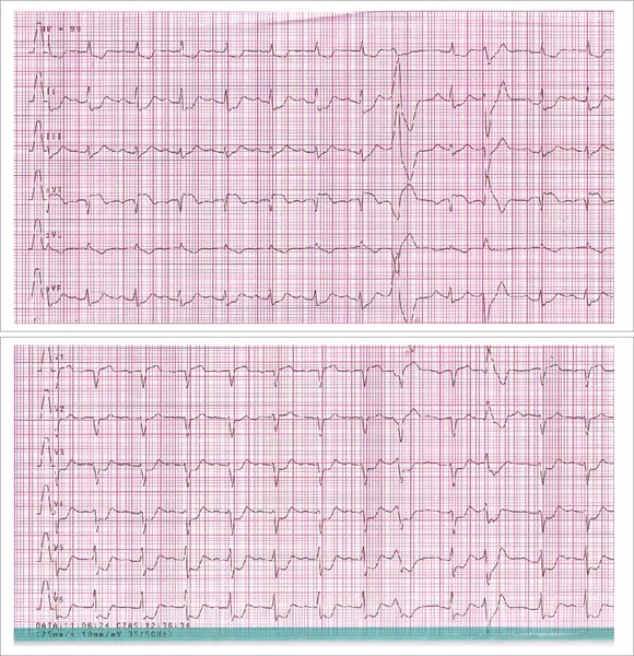 Rycina 1. Uniesienie ST w aVR współistniejące z obniżeniami ST w ośmiu odprowadzeniach. EKG 61-letniego mężczyzny z wywiadem bólu wieńcowego trwającego godzinę. W wykonanej w trybie pilnym koronarografii stwierdzono 70% zwężenie pnia lewej tętnicy wieńcowej oraz 80% zwężenie środkowego segmentu gałęzi przedniej zstępującej. Chorego przekazano do pilnej interwencji kardiochirurgicznej.