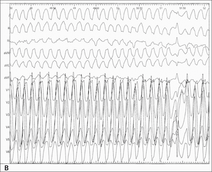 Rycina 1. [A] EKG wykonane w trakcie pierwszej hospitalizacji. Rozpoznano blok prawej odnogi pęczka Hisa. Pominięto objawy zespołu preekscytacji. [B] EKG zapisane w trakcie badania elektrofizjologicznego. Migotanie przedsionków z przewodzeniem do komór lewostronną drogą dodatkową. Bardzo krótkie odstępy RR 180-210 ms. Częstość zespołów QRS ok. 300/min.