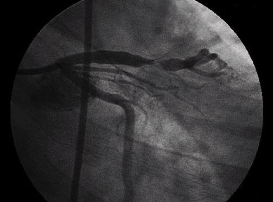  Rycina 3. Angiogram tętnic wieńcowych chorego przedstawionego w artykule