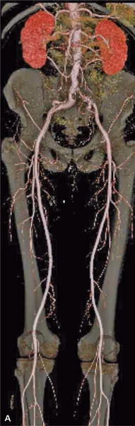 RYCINA 1. Angiografia TK (rekonstrukcje VR [A] i MIP [B]) tętnic obwodowych, angiografia TK (rekonstrukcja VR) serca i tętnic wieńcowych [C] oraz angiografia TK aorty (warstwa poprzeczna na poziomie tętniaka aorty brzusznej) [D] u pacjenta z podejrzeniem choroby wieńcowej. Badanie uwidoczniło prawidłowy obraz tętnic wieńcowych, rozwarstwienie w tętniaku aorty brzusznej, obecność podwójnych tętnic nerkowych, krytyczne zwężenie lewej tętnicy biodrowej wspólnej (Kardiol Dypl 2006; 5 (4): 97-100).