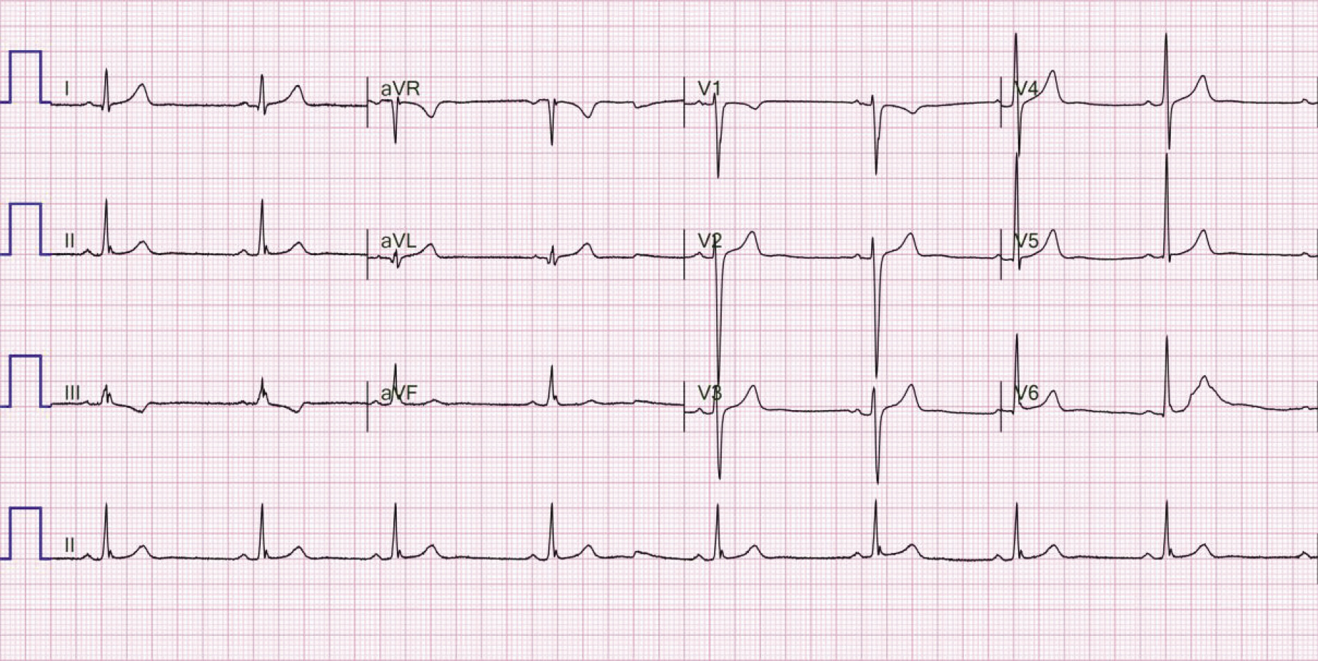 Rycina 2. Zapis 12-odprowadzeniowego EKG 22-letniego pacjenta z arytmogenną kardiomiopatią prawokomorową po przebytym nagłym zatrzymaniu krążenia w mechanizmie migotania komór. Widoczna fragmentacja zespołu QRS w odprowadzeniach znad ściany dolnej. Ponadto iloraz sumy czasu trwania zespołów QRS w odprowadzeniach V1-V3 oraz czasu trwania zespołu QRS w odprowadzeniach V4-V6 wynosi ok. 1,5