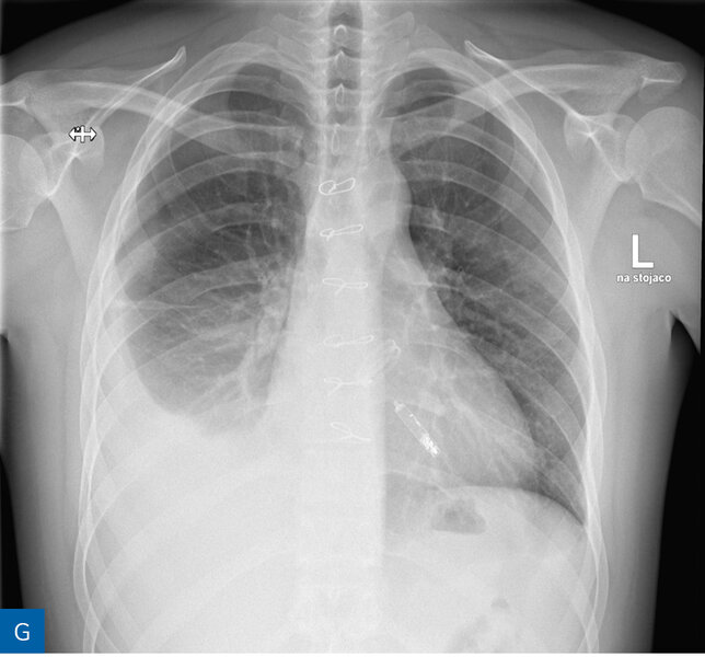 Rycina 1. Obraz radiologiczny w procesie identyfikacji kardiologicznego urządzenia wszczepialnego (CIED). A. Rozrusznik dwujamowy. B. Kardiowerter-defibrylator dwujamowy. C. Kardiowerter-defibrylator podskórny. D. Urządzenie do terapii resynchronizującej z funkcją defibrylacji E. Pętlowy rejestrator zdarzeń oraz rozrusznik dwujamowy. F. Stymulator bezelektrodowy typu Micra. G. Stymulator bezelektrodowy Abbott AVEIR. H. Układ poprawiający kurczliwość mięśnia sercowego (strona prawa) oraz kardiowerter-defibrylator jednojamowy (strona lewa)