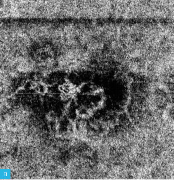 Rycina 1A-C. Zwyrodnienie plamki żółtej związane z wiekiem (AMD) – postać wysiękowa. A. Na obrazach angiografii opartej na optycznej koherentnej tomografii (angio-OCT) widoczny nieprawidłowy przepływ w obszarze neowaskularyzacji naczyniówkowej (CNV) na poziomie siatkówki zewnętrznej. B. Nieprawidłowy przepływ w CNV na poziomie choriokapilar. C. W optycznej koherentnej tomografii (OCT) widoczne zwiększenie grubości siatkówki, spłycenie dołeczka, płyn podsiatkówkowy i nieregularne odwarstwienie nabłonka barwnikowego siatkówki (RPE)