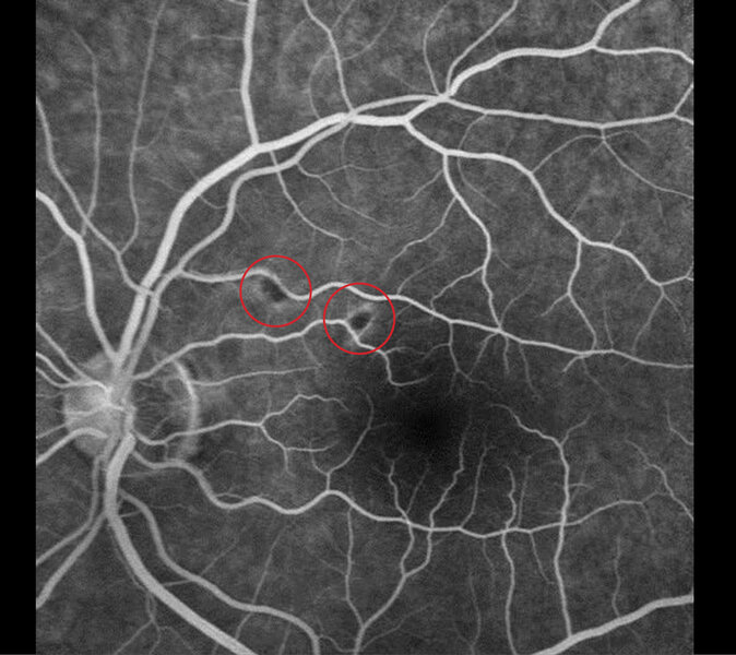 Rycina 1. Angiografia fluoresceinowa: w miejscach tzw. kłębków waty na dnie oka lewego obecna stała hipofluorescencja braku perfuzji włośniczkowej z zachowanym prawidłowym przepływem krwi w dużych naczyniach żylnych bez przecieku