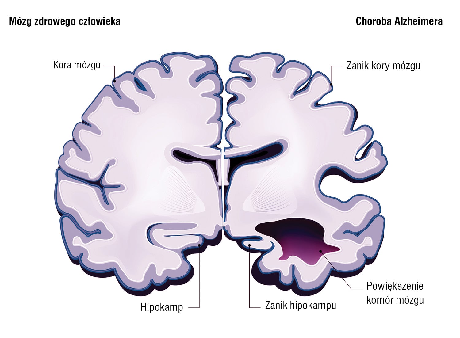Choroba Alzheimera