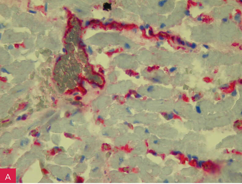Rycina 1A i B. Przewlekłe aktywne zapalenie mięśnia sercowego (ZMS) w badaniu immunohistochemicznym skrawków mrożeniowych.  A. Silna, naczyniowa ekspresja antygenów HLA klasy I (A, B, C) z towarzyszącą stazą. B. Bardzo liczne uszkadzające nacieki makrofagalne (CD68+) z ogniskami martwicy kardiomiocytów