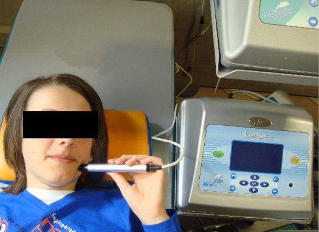 Ryc. 4. Aplikator punktowy na otwór nerwu żuchwowego, zewnątrzustnie.