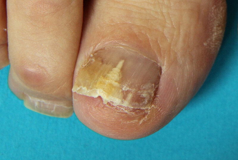 Ryc. 1. Grzybica dermatofitowa paznokci.