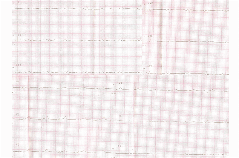 Rycina 1. EKG u bezobjawowej chorej z dużą ilością płynu w worku osierdziowym.