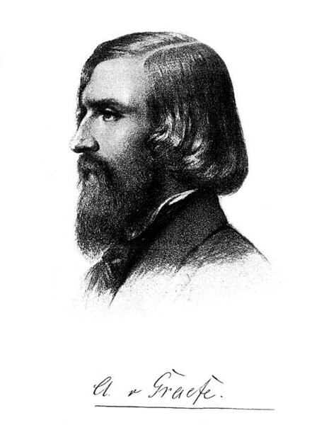 Ryc. 5. Albrecht von Gräfe, czyli udoskonalenie techniki usunięcia zaćmy.