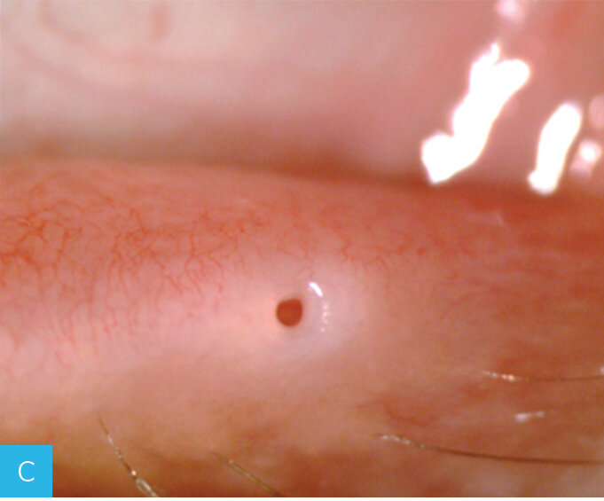 Rycina 1A-C. Leczenie zwężenia punktu łzowego za pomocą implantów perforowanych. A. Stenoza dolnego punktu łzowego. B. Implant perforated plug (firmy FCI) wszczepiony do punktu łzowego. C. Punkt łzowy po usunięciu implantu
