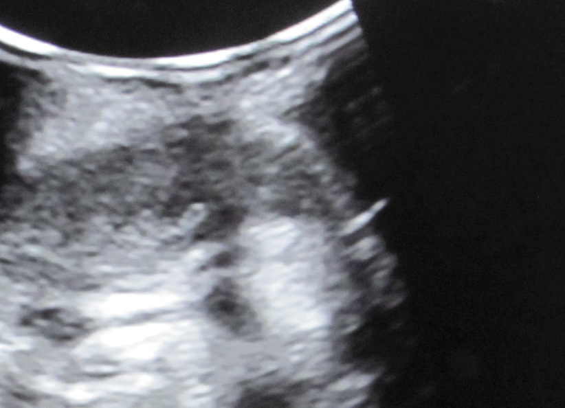 Rycina 5. Obraz ultrasonograficzny nerki i igły bezpośrednio przed biopsją.