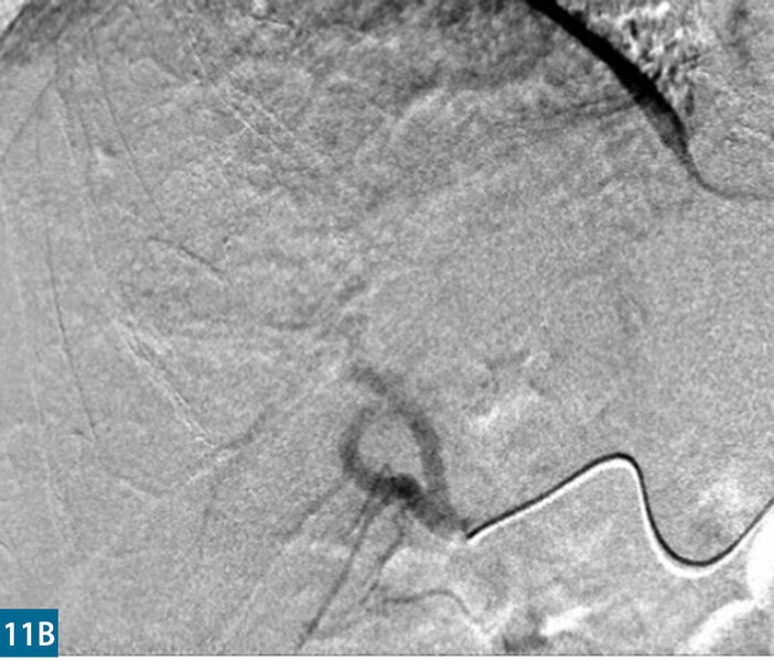 Rycina 11. Arteriografia przed TACE (A) i po TACE (B)
