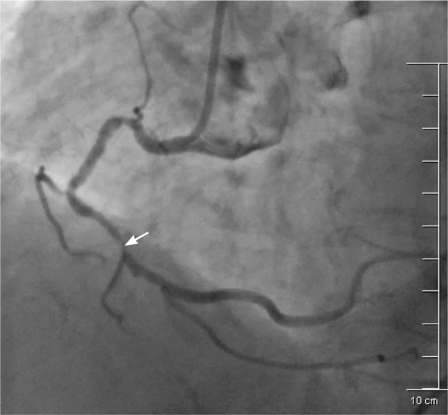 Rycina 2. Angiogram prawej tętnicy wieńcowej z istotnym zwężeniem w środkowym segmencie naczynia. W początkowym odcinku naczynia zwraca uwagę duże zagięcie, które istotnie pogarsza warunki potencjalnej angioplastyki wieńcowej.
