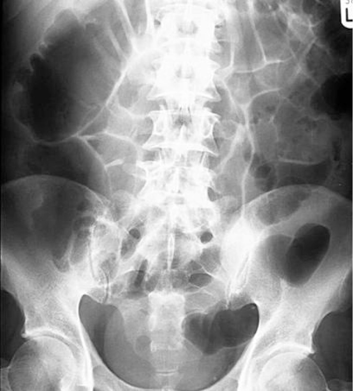  Rycina 4. Toksyczne rozdęcie okrężnicy, które może występować w ciężkiej postaci zakażenia C. difficile. Przeglądowe zdjęcie rentgenowskie jamy brzusznej przedstawiające rozdęcie jelita grubego z obrzękiem śluzówki (strzałka)