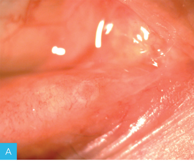 Rycina 1A-C. Leczenie zwężenia punktu łzowego za pomocą implantów perforowanych. A. Stenoza dolnego punktu łzowego. B. Implant perforated plug (firmy FCI) wszczepiony do punktu łzowego. C. Punkt łzowy po usunięciu implantu