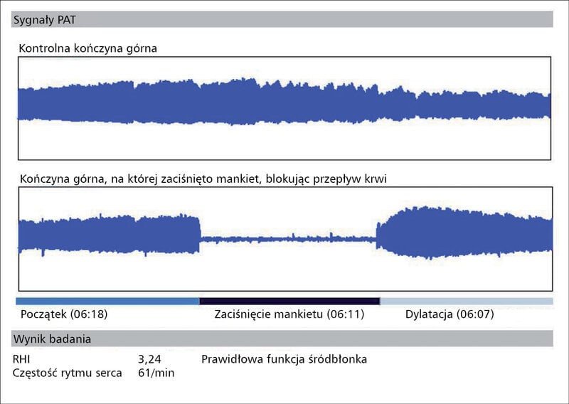 Rycina 3. Wynik badania czynności śródbłonka u&nbsp;młodego mężczyzny bez czynników ryzyka rozwoju choroby wieńcowej. RHI (reactive hiperemia index) – wskaźnik reaktywnego przekrwienia.