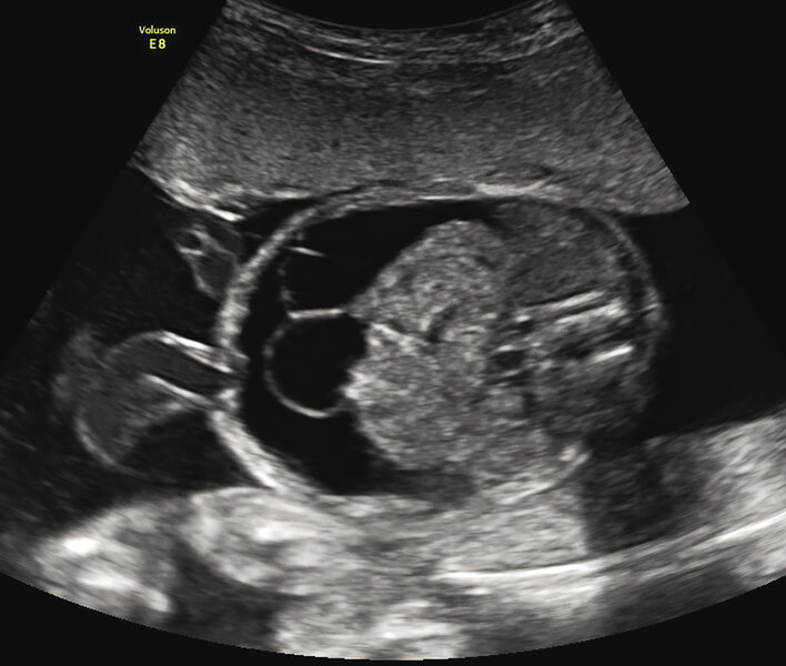 Rycina 1. 22 tydzień ciąży; C I, P I. Wodobrzusze u płodu spowodowane ciężką niedokrwistością w przebiegu konfliktu serologicznego w układzie Kell (Hb 1,7 mg/dl, Ht 5,5%, E 0,4 mln/μl).  Pacjentka zakwalifikowana do leczenia wewnątrzmacicznego transfuzjami dopłodowymi – obrzęk ustąpił po trzeciej transfuzji