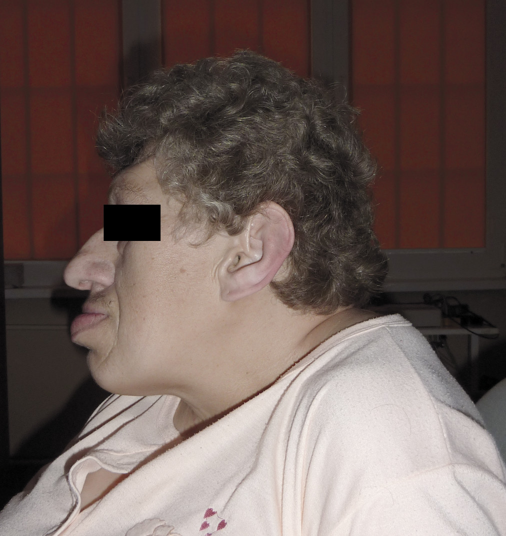 Fot. 3. Charakterystyczne zmiany rysów twarzy pacjentki w przebiegu akromegalii.