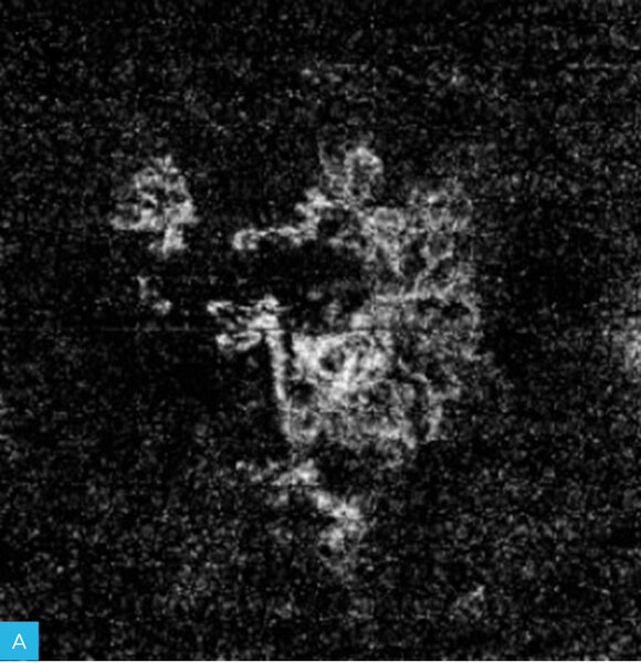 Rycina 1A-C. Zwyrodnienie plamki żółtej związane z wiekiem (AMD) – postać wysiękowa. A. Na obrazach angiografii opartej na optycznej koherentnej tomografii (angio-OCT) widoczny nieprawidłowy przepływ w obszarze neowaskularyzacji naczyniówkowej (CNV) na poziomie siatkówki zewnętrznej. B. Nieprawidłowy przepływ w CNV na poziomie choriokapilar. C. W optycznej koherentnej tomografii (OCT) widoczne zwiększenie grubości siatkówki, spłycenie dołeczka, płyn podsiatkówkowy i nieregularne odwarstwienie nabłonka barwnikowego siatkówki (RPE)
