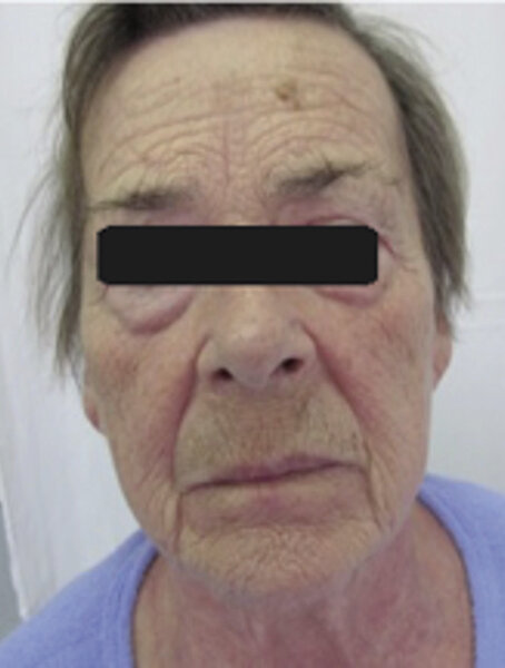 Ryc. 13-14. Dermatomyositis.