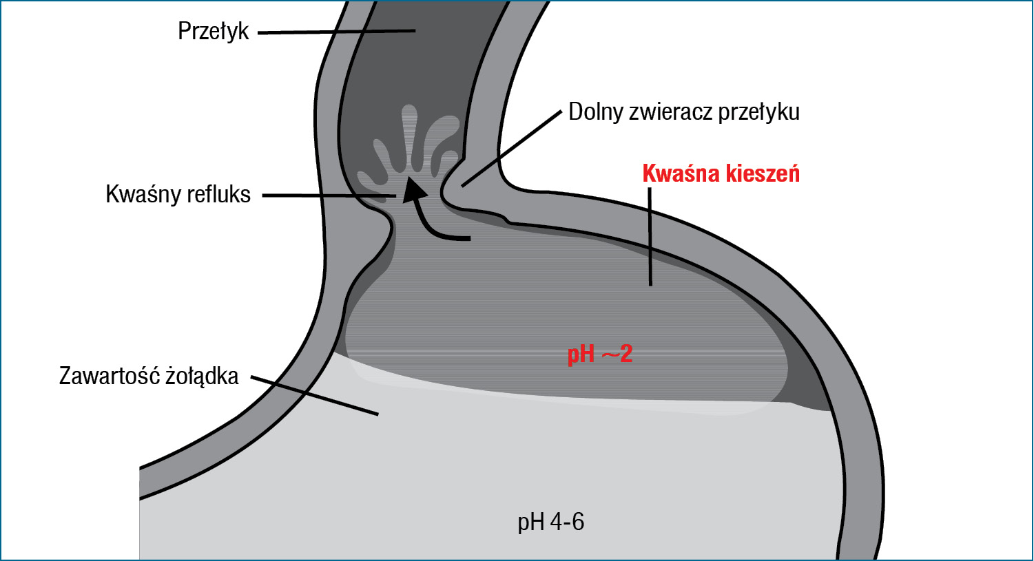 Rycina 1. Poposiłkowa kwaśna kieszeń (na podstawie 4 pozycji piśmiennictwa) 
