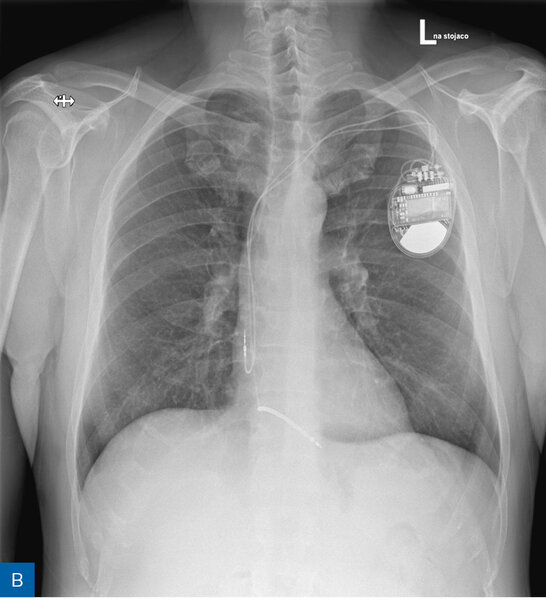 Rycina 1. Obraz radiologiczny w procesie identyfikacji kardiologicznego urządzenia wszczepialnego (CIED). A. Rozrusznik dwujamowy. B. Kardiowerter-defibrylator dwujamowy. C. Kardiowerter-defibrylator podskórny. D. Urządzenie do terapii resynchronizującej z funkcją defibrylacji E. Pętlowy rejestrator zdarzeń oraz rozrusznik dwujamowy. F. Stymulator bezelektrodowy typu Micra. G. Stymulator bezelektrodowy Abbott AVEIR. H. Układ poprawiający kurczliwość mięśnia sercowego (strona prawa) oraz kardiowerter-defibrylator jednojamowy (strona lewa)