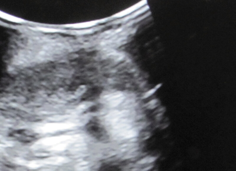 Rycina 5. Obraz ultrasonograficzny nerki i igły bezpośrednio przed biopsją.