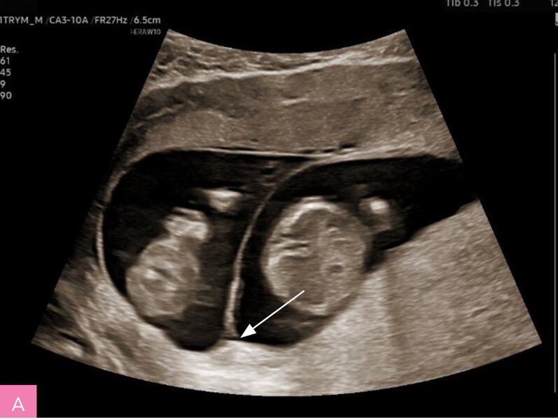 Rycina 1A, B. Badanie ultrasonograficzne wykonane w I trymestrze ciąży. A. Ciąża bliźniacza dwukosmówkowa dwuowodniowa, płody są oddzielone grubą warstwą 2 błon kosmówki i 2 błon owodni (objaw λ). B. Ciąża bliźniacza jednokosmówkowa dwuowodniowa, płody są oddzielone tylko 2 cienkimi warstwami owodniowymi (objaw τ)