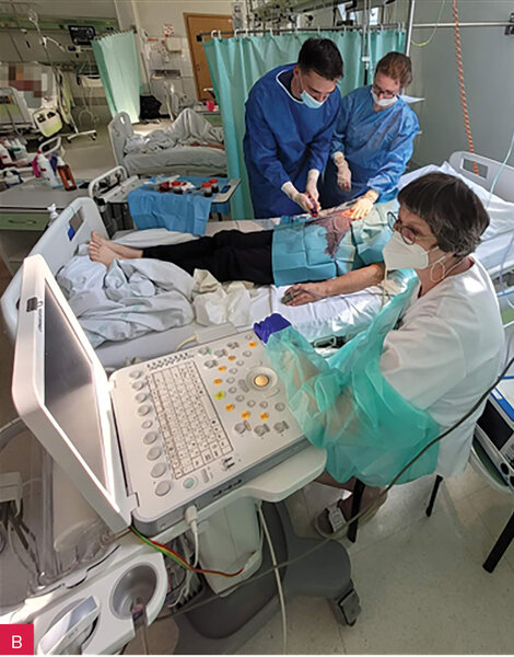 Rycina 13A, B. Zabieg odbarczania tamponady monitorowany echokardiograficznie. A. Na pierwszym planie echokardiografista monitorujący, ręka z głowicą umieszczona pod jałową serwetą. Aparat ustawiony przy głowie pacjenta (nie jest widoczny, jego ustawienie wskazuje żółta strzałka), praworęczny echokardiografista musi krzyżować ręce, aby operować gałkami aparatu. B. Na pierwszym planie echokardiografista monitorujący, ręka z głowicą umieszczona pod jałową serwetą, nie jest widoczna. Aparat ustawiony przy nogach pacjenta, praworęczny echokardiografista bez problemu uzyskuje obrazy prawą ręką, lewą operując gałkami aparatu. (Zdjęcia z Oddziału Intensywnej Opieki Kardiologicznej Kliniki Chorób Wewnętrznych i Kardiologii WUM, za zgodą kierownika kliniki oraz lekarzy widocznych na zdjęciach)