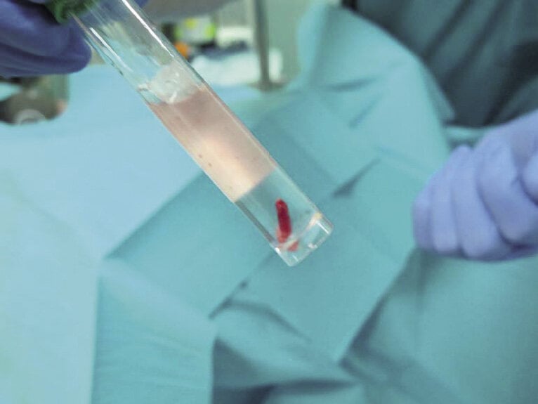  Rycina 7. Trepanobiopsja szpiku – pobrany walec kostny. 