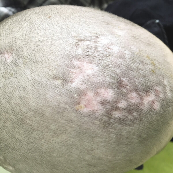 Rycina 3. Grzybica owłosionej skóry głowy wywołana przez Microsporum canis