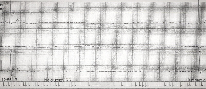 Rycina 1. Fragment zapisu z badania EKG metodą Holtera. Pauza trwająca 7138 ms zarejestrowana w trakcie snu u pacjenta z ciężkim obturacyjnym bezdechem sennym
