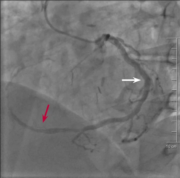 Rycina 3. Angiogram lewej tętnicy wieńcowej – prawa tętnica wieńcowa (czerwona strzałka) odchodzi od gałęzi okalającej (biała strzałka).