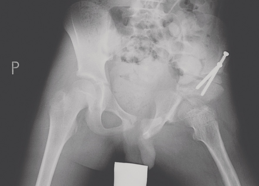 Ryc. 4. Zdjęcie rtg miednicy dziewięcioletniego chłopca po operacji super hip/super knee lewego biodra z potrójną osteotomią miednicy.