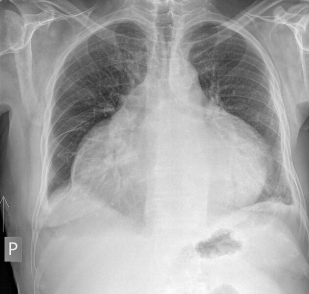Rycina 2. Bardzo duża ilość płynu w worku osierdziowym u 79-letniego mężczyzny po przedawkowaniu acenokumarolu, interwencja kardiochirurgiczna. W diagnostyce krwistego płynu – nieswoiste komórki zapalne. Idiopatyczne zapalenie osierdzia