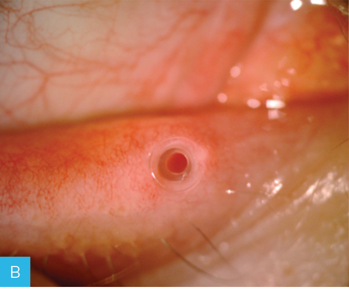 Rycina 1A-C. Leczenie zwężenia punktu łzowego za pomocą implantów perforowanych. A. Stenoza dolnego punktu łzowego. B. Implant perforated plug (firmy FCI) wszczepiony do punktu łzowego. C. Punkt łzowy po usunięciu implantu