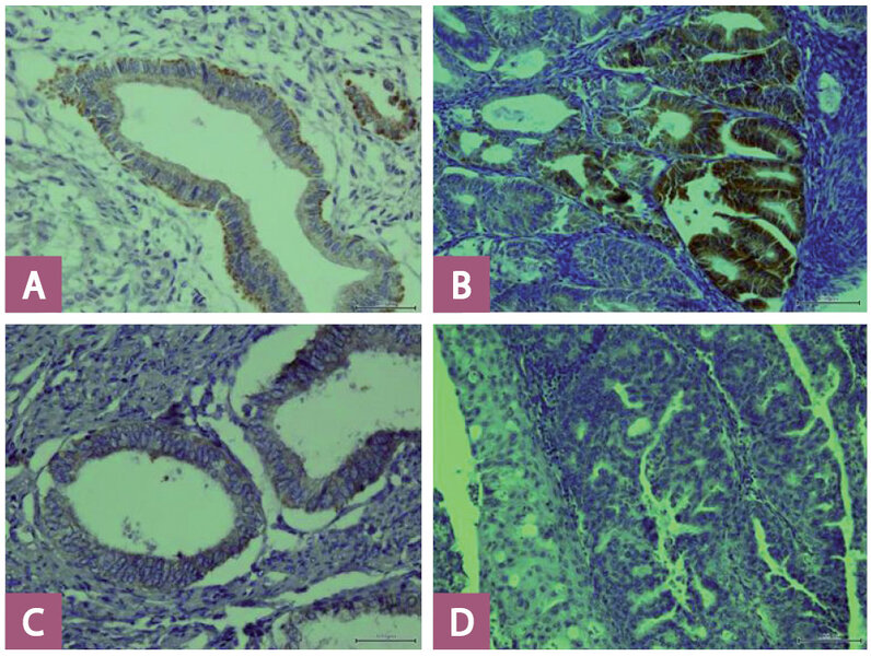 Ryc. 2. A – obecna ekspresja błonowa DR4 w prawidłowym endometrium (powiększenie 400 ×); B – obecna ekspresja błonowa DR4 w raku endometrium (powiększenie 400 ×); C – obecna ekspresja błonowa DR5 w prawidłowym endometrium (powiększenie 400 ×); D – brak ekspresji błonowej DR5 w raku endometrium (powiększenie 400 ×).