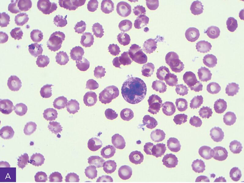 Rycina 10. Ziarnistość toksyczna w granulocytach obojętnochłonnych, wodniczki w monocytach. A. Neutrofil.  B. Monocyt. C. Granulocyt pseudopelgeropodobny